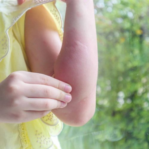 Ekzem Außenseite Arm