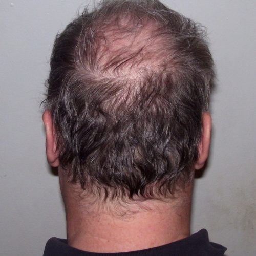 Haarausfall am Hinterkopf eines Mannes