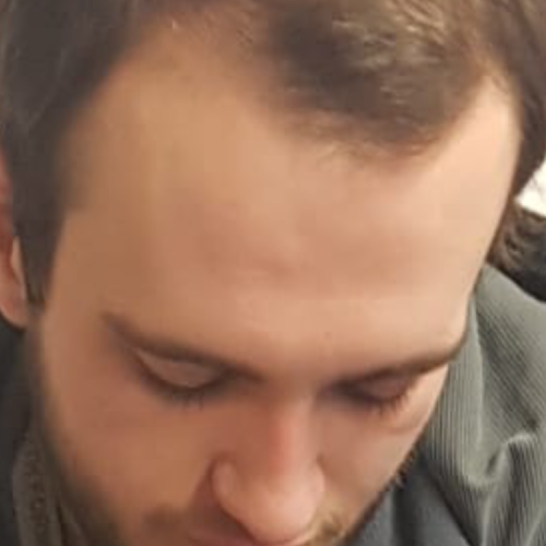 Geheimratsecken bei einem Mann