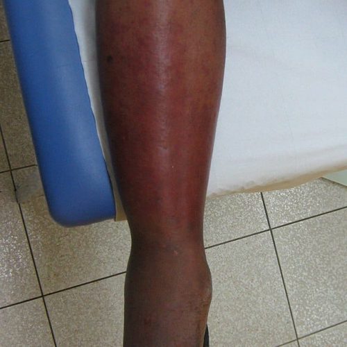 Erysipel Unterschenkel