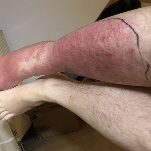 Erysipel Unterschenkel