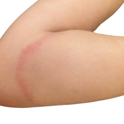 Erythema Chonicum migrans