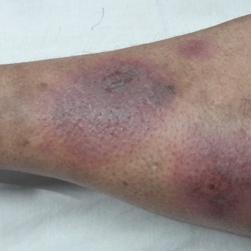 Erythema nodosum auf dem Schienbein