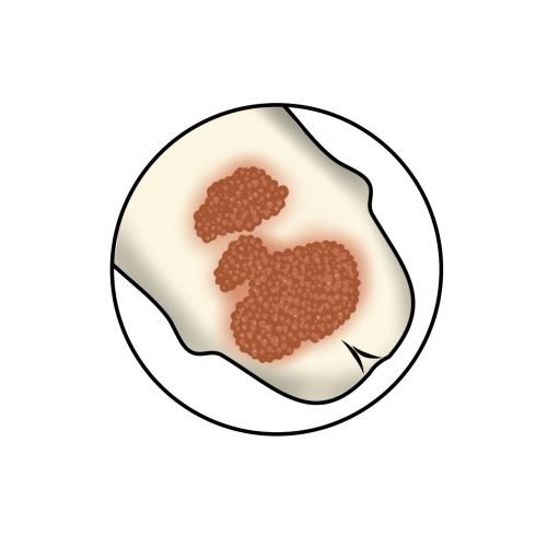 Feigwarze (Condylomata accuminata)