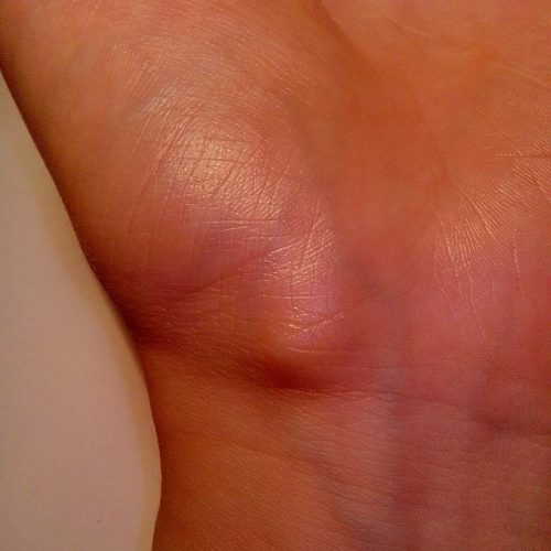 Ganglion am Handrücken