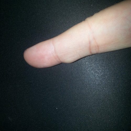 Ganglion am Finger