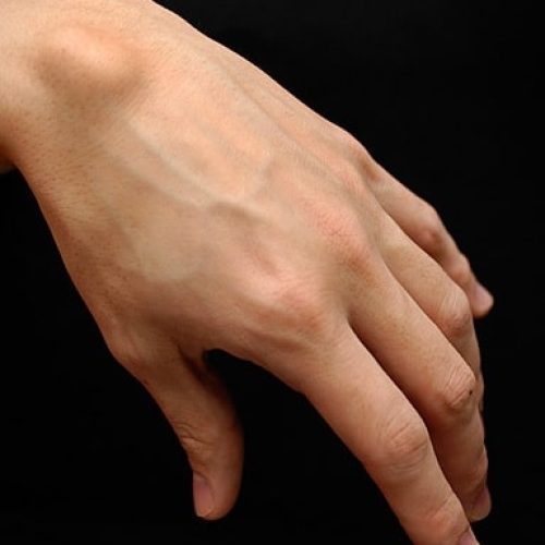 Ein Ganglion am Handgelenk