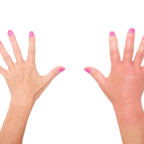 Insektenstich Allergie