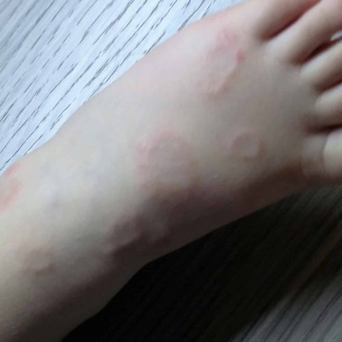 Granuloma anulare am Kinderfuß