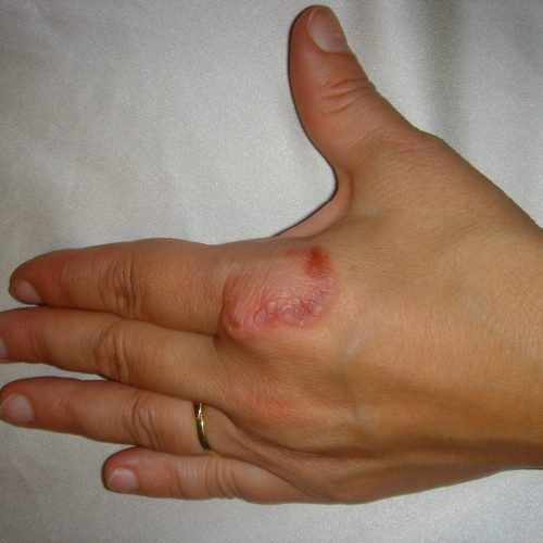 Granuloma anulare stickstoffbehandelt