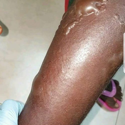 Großblasiger Impetigo