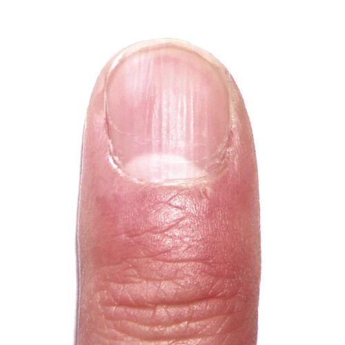 Grübchenbildung bei Nagelpsorisasis