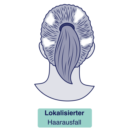 Lokalisierter Haarausfall