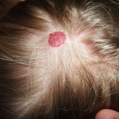 Blutschwämmchen am Kopf