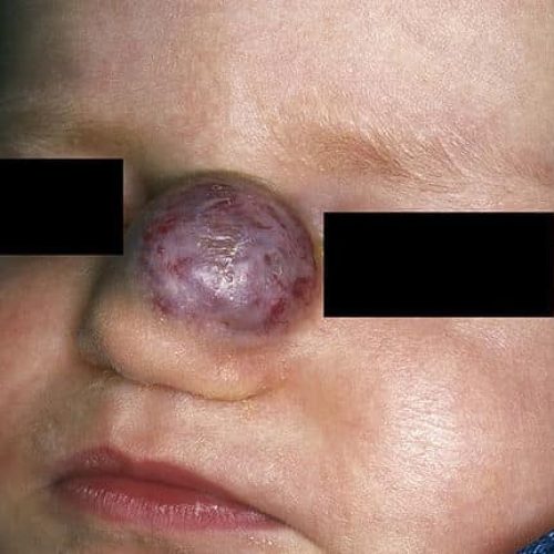 Blutschwämmchen auf der Nase