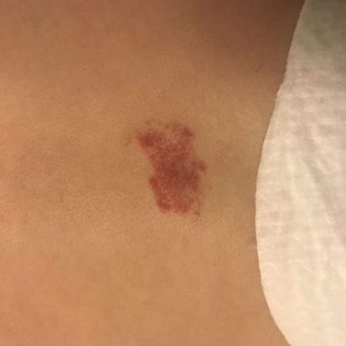 Blutschwämmchen am Rumpf