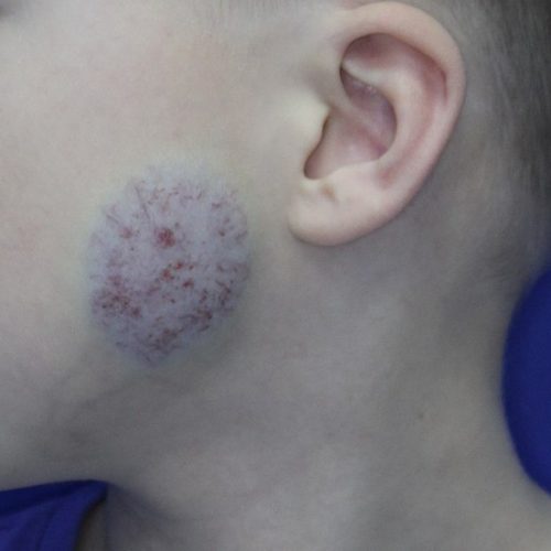 Blutschwämmchen Wange