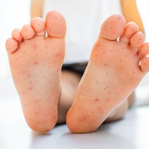 Hand-Fuß-Mund-Krankheit, Fußsohlen