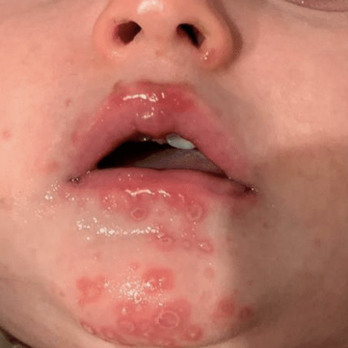 Hand-Fuß-Mundkrankheit