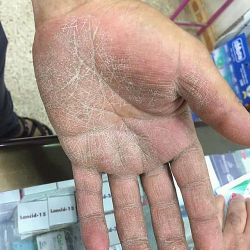 Handpilz, Handfläche