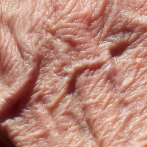 Gealterte Haut am Handrücken