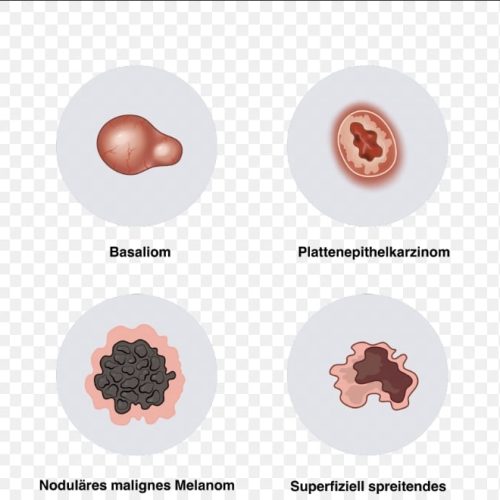 Eine gute und ausführliche Übersicht der Hauttumore