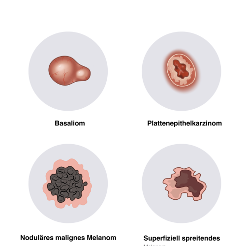 Eine gute und ausführliche Übersicht der Hauttumore