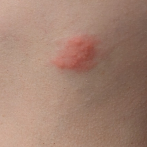 Gürtelrose im Bereich der Rippen