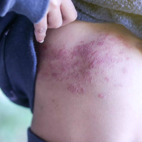 Gürtelrose im Bereich der Rippen