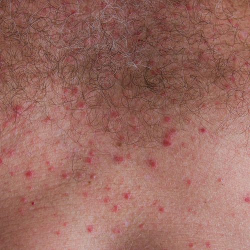 Kleine rote Hitzepickel auf Brust eines Mannes