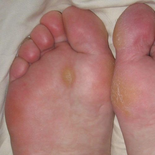 Hornhaut am Fußballen und dem großen Zeh