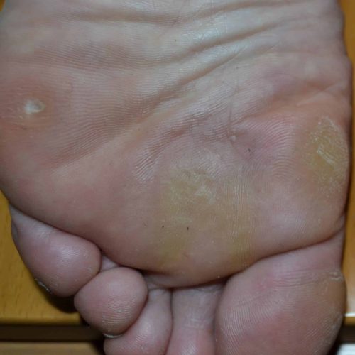 Fußsohle mit einem Hühnerauge kleinzehenseitig und Hornhaut am Ballen