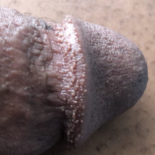 Hornzipfel beim dunklen Hauttyp