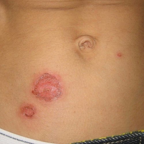 Impetigo am Bauch