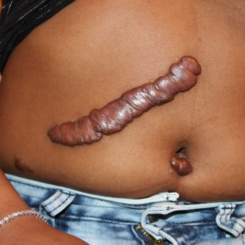 Keloid am Bauch