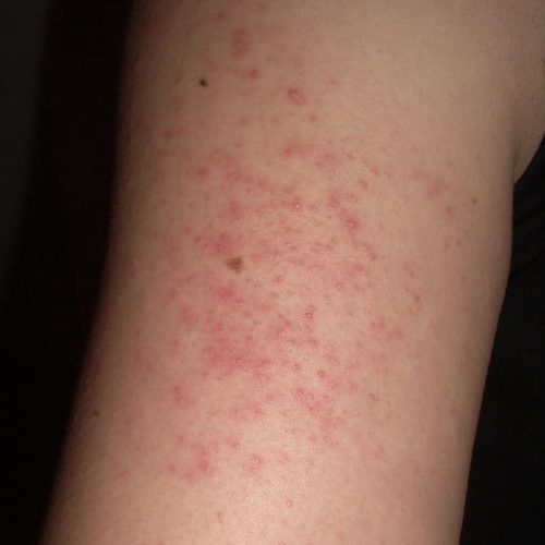 Keratosis pilaris Arm