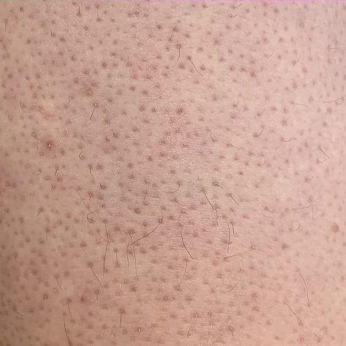 Keratosis pilaris Bein