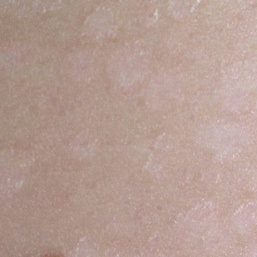 Kleienpilzflechte Läsionen