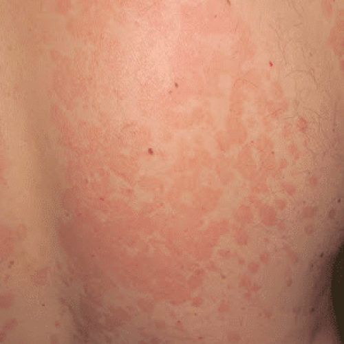 Kleienpilzflechte Rücken