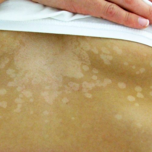 Kleienpilzflechte helle Flecken