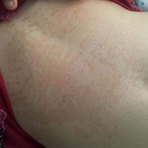 Kleienpilzflechte rote Hautveränderungen