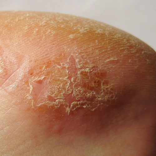 Chronisches Kontaktekzem am Fuss
