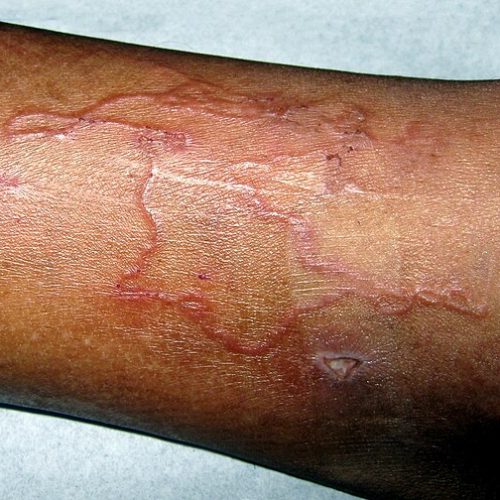 Larva Migrans, Unterschenkel