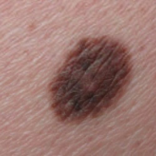 Unauffälliges Muttermal an der linken Gesäßhälfte