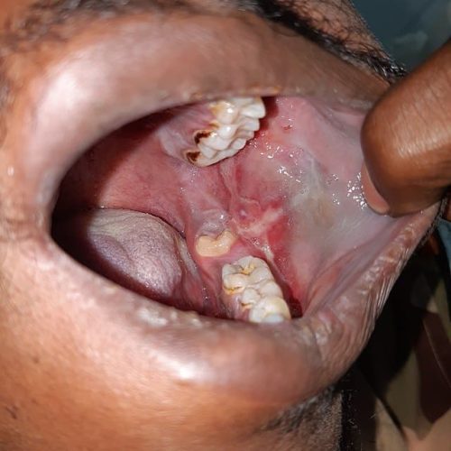 Knötchenflechte Mund