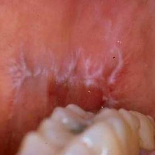 Knötchenflechte Wickham's