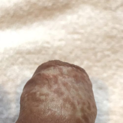 Lichen Sclerosus, Vorhaut