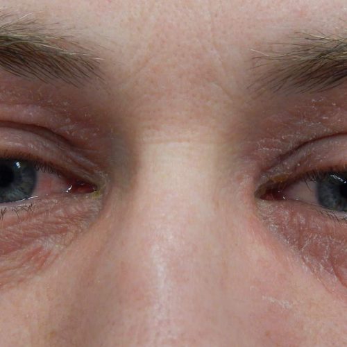 Augen mit geröteten Lidern und Lidekzem um beide Augen herum