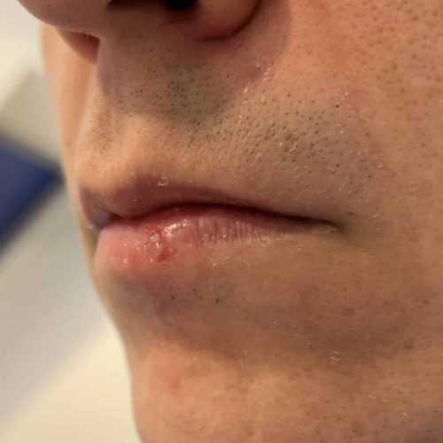 Lippenherpes 1