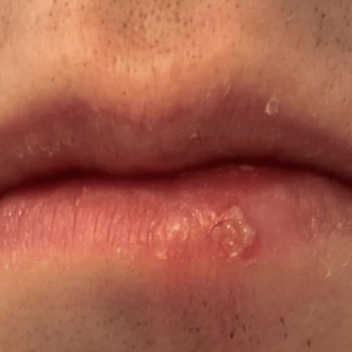 Lippenherpes 2